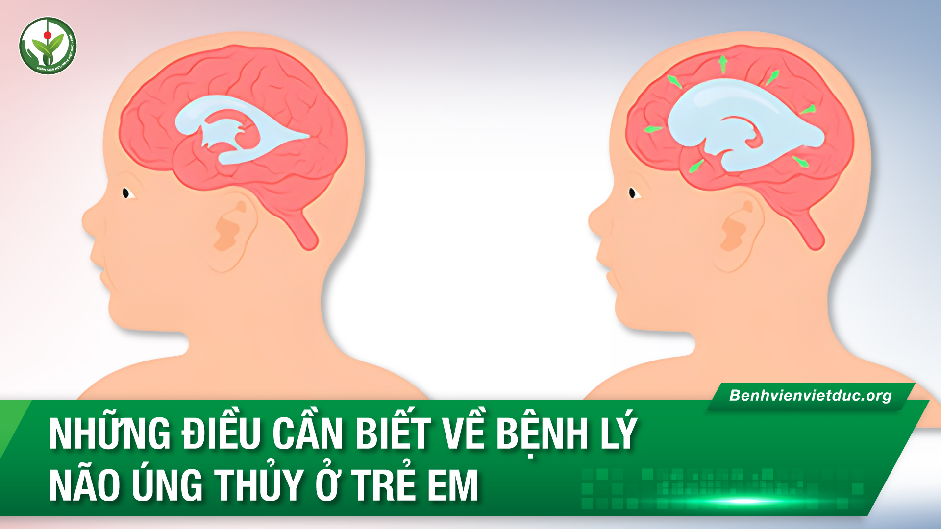 não úng thủy ở trẻ sơ sinh