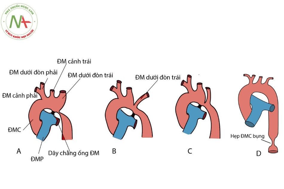 Xét nghiệm di truyền hội chứng Noonan