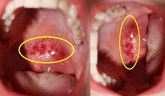 Ô nhiễm không khí làm tăng nguy cơ viêm họng mạn