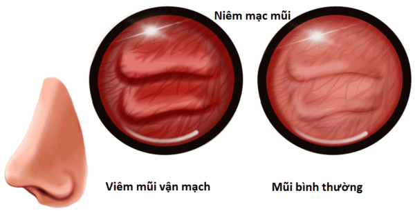 Viêm Mũi Vận Mạch Là Gì? Triệu Chứng, Nguyên Nhân và Cách Điều Trị Hiệu Quả 7 Hình ảnh cấu trúc mũi khi bị viêm mũi vận mạch
