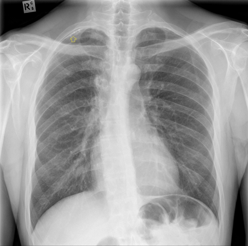 Vôi hóa màng phổi trên phim X-quang