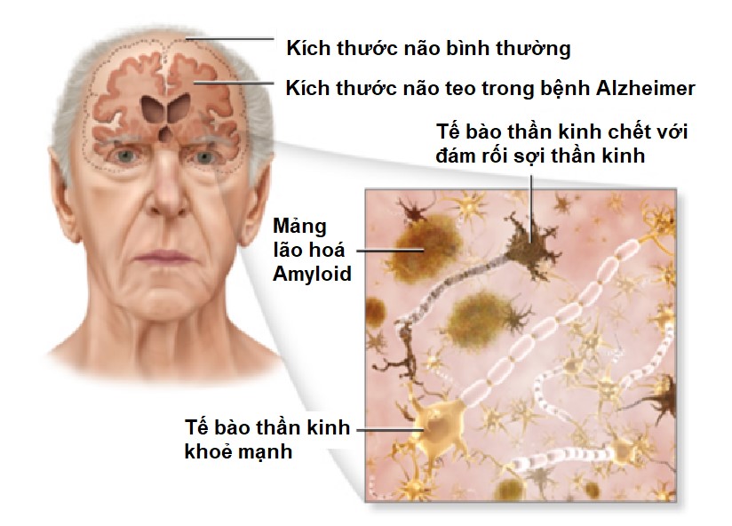 Cơ chế gây bệnh Alzheimer và mức độ teo não