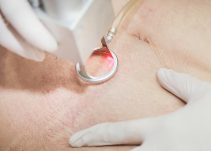 Điều trị rạn da bằng laser