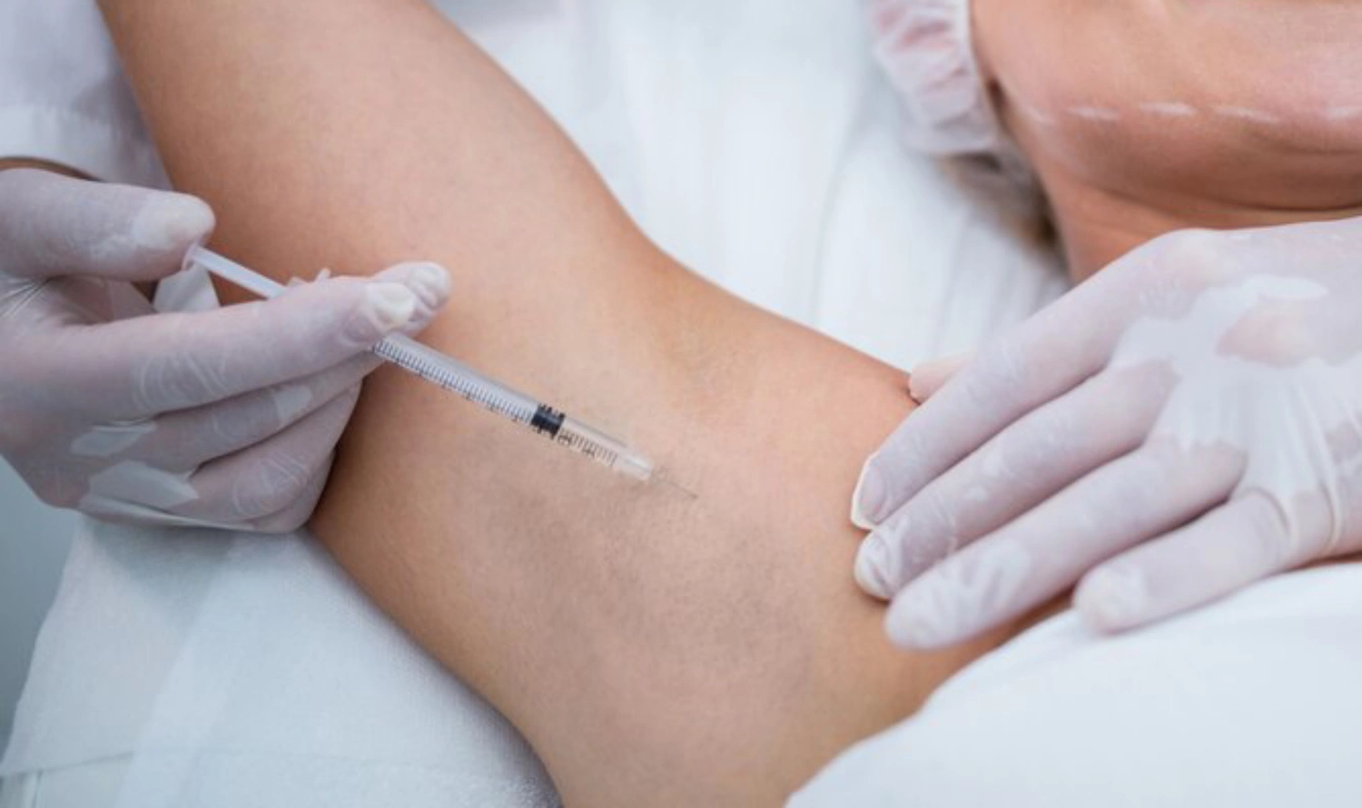 bác sĩ tiêm botox trị hôi nách