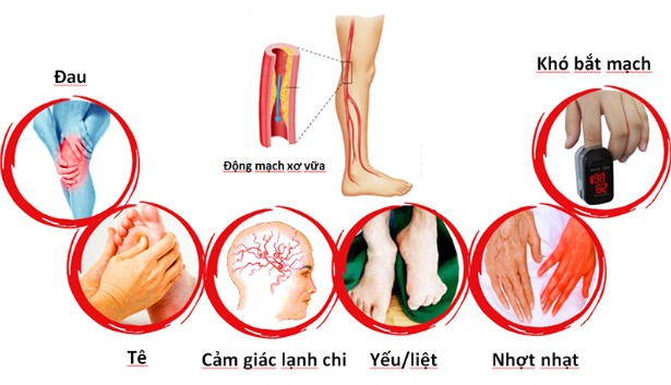 bệnh động mạch ngoại biên là gì