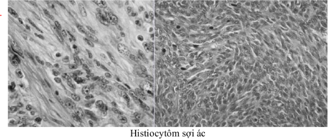 Sarcoma Kaposi là gì? Triệu chứng, Nguyên nhân và Hướng điều trị 8 Tổn thương da Sarcoma Kaposi