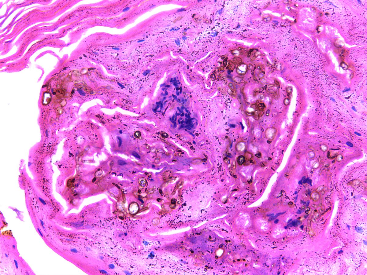 Chromoblastomycosis: Bệnh nấm da mạn tính ít gặp nhưng dai dẳng 8 Hình ảnh mô học của Chromoblastomycosis