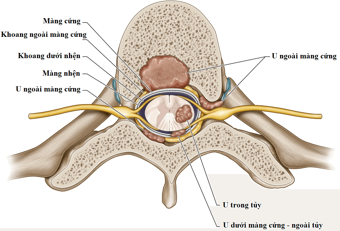 Hình ảnh cộng hưởng từ tủy sống bị chèn ép bởi u