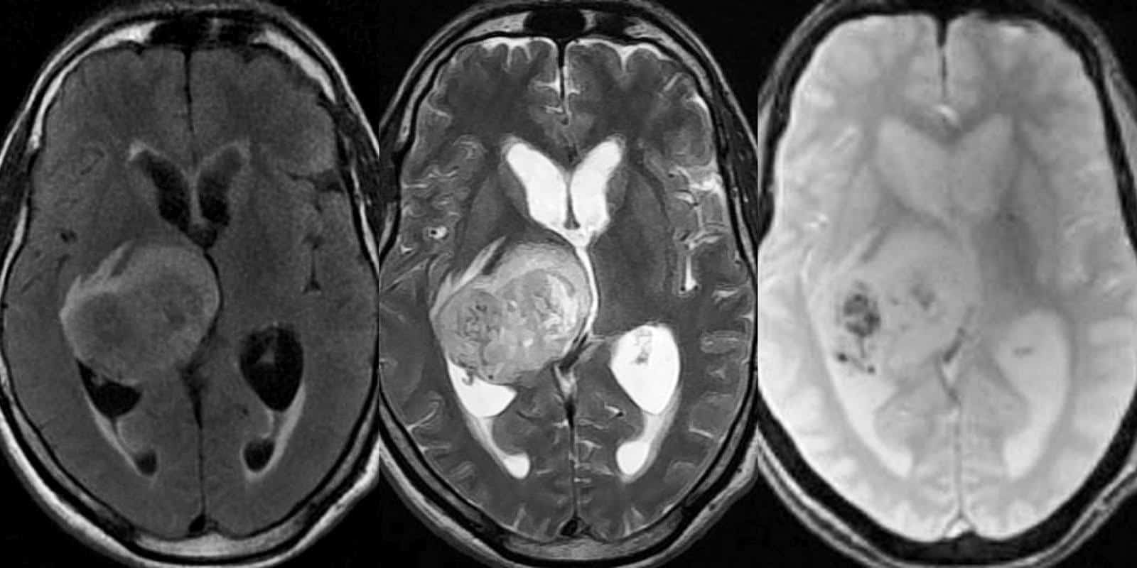 MRI não cho thấy khối u sao bào