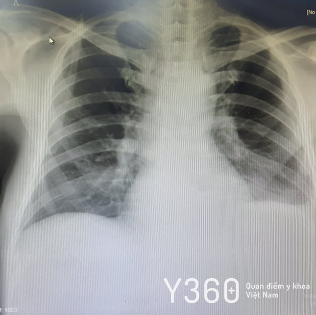 Lymphoma màng phổi: Hiểu đúng để phát hiện và điều trị kịp thời 4 Hình ảnh lymphoma màng phổi trên X-quang
