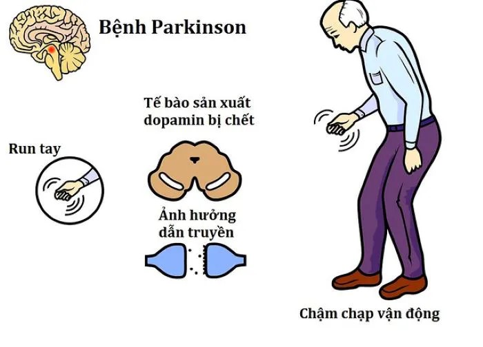 Run tay do Parkinson