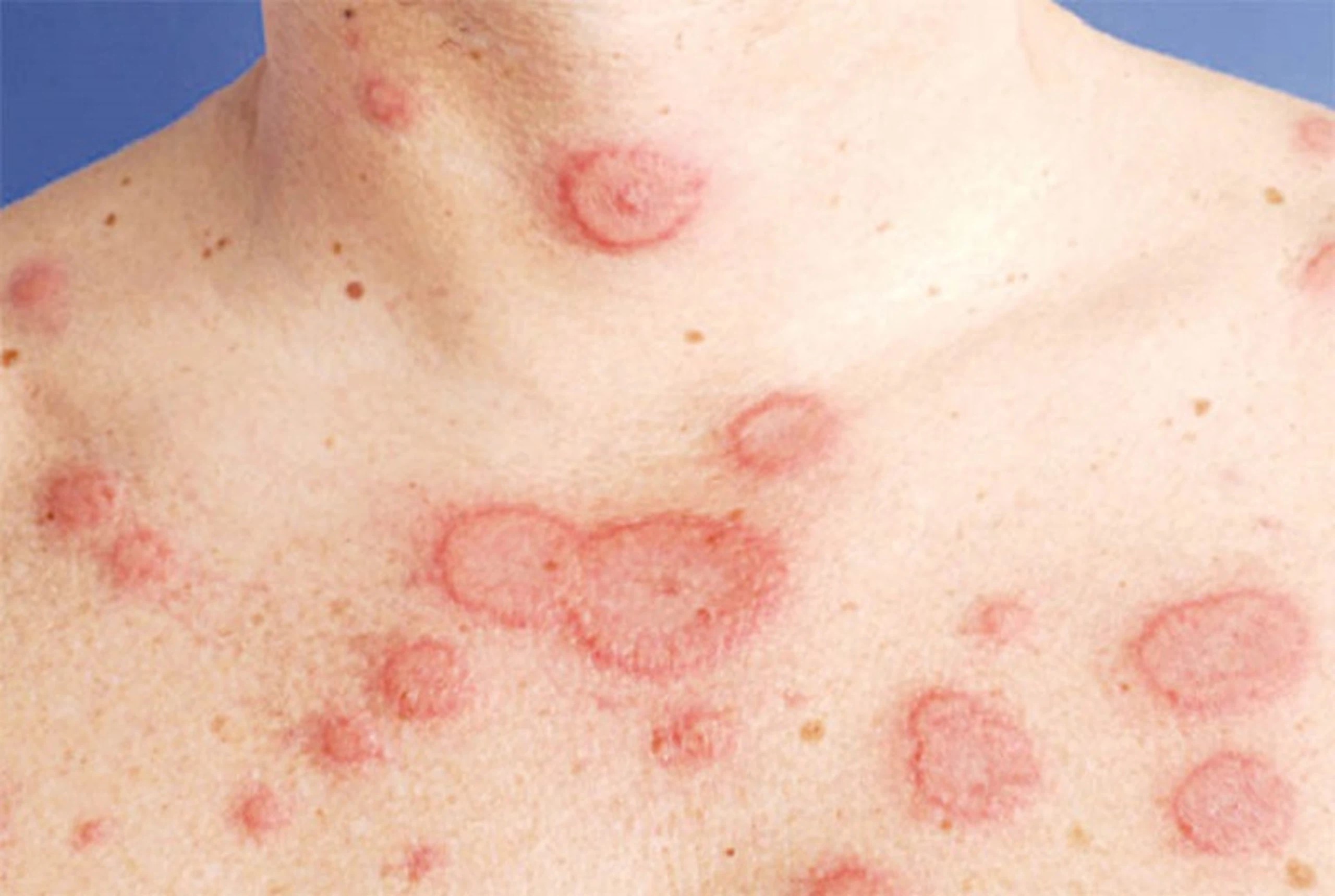 Khám và tư vấn bệnh lupus ban đỏ