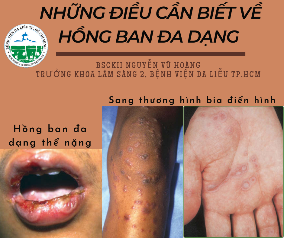 dị ứng thuốc gây hồng ban đa dạng