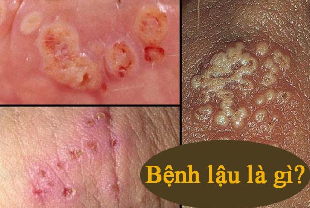 Vi khuẩn lậu cầu Neisseria gonorrhoeae dưới kính hiển vi
