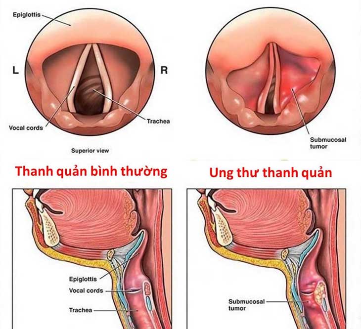 Nội soi phát hiện u nang dây thanh