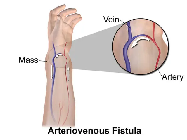 Minh họa chẩn đoán hình ảnh AVF