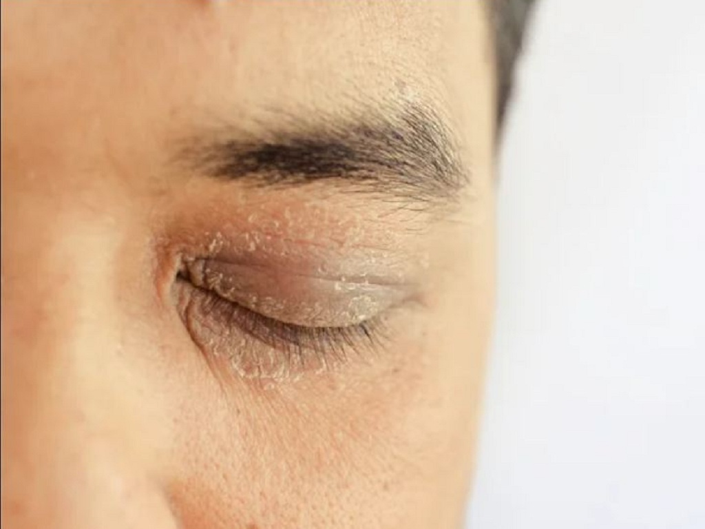 Viêm da mí mắt dị ứng: Nguyên nhân, triệu chứng và cách điều trị hiệu quả 8 Viêm da mí mắt dị ứng nặng