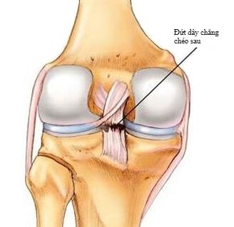 Hình ảnh dây chằng chéo sau bị đứt trên MRI