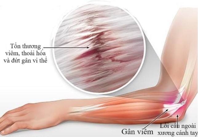Hình ảnh mô phỏng viêm lồi cầu ngoài xương cánh tay