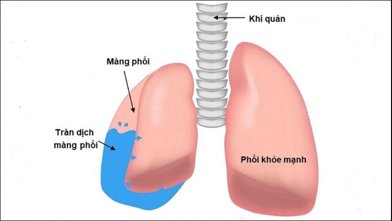 Nguyên nhân tràn dịch màng phổi