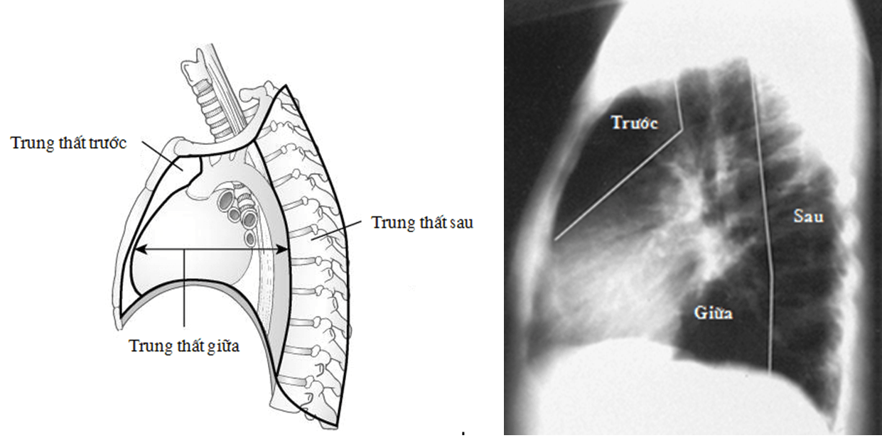 U lympho trung thất: Triệu chứng, chẩn đoán và điều trị hiệu quả 8 Ảnh chụp X-quang khối u trung thất