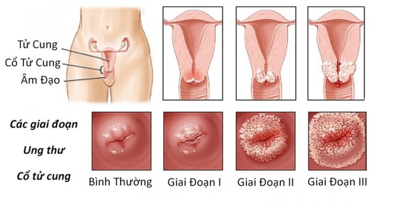 Soi cổ tử cung