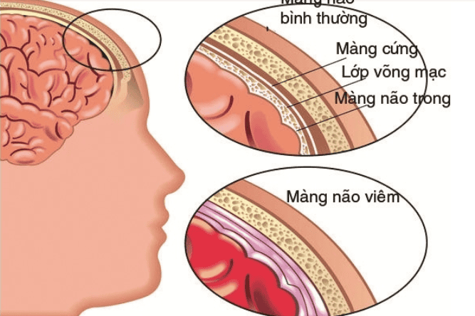 biến chứng viêm màng não mủ