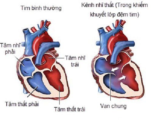 Hình ảnh minh họa kênh nhĩ thất chung