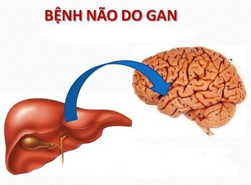 MRI não Wernicke