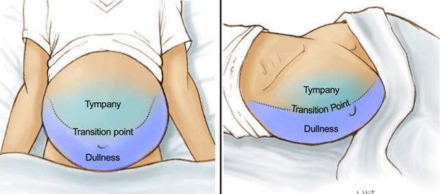 Bụng Chướng Lệch Một Bên: Nguyên Nhân, Dấu Hiệu và Cảnh Báo Bệnh Lý Nguy Hiểm 7 Minh họa bụng chướng lệch một bên