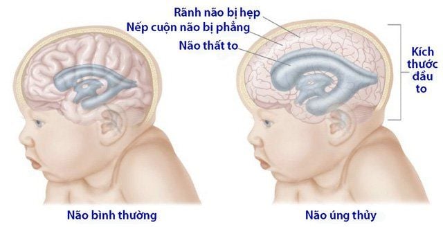não úng thủy hình ảnh CT scan