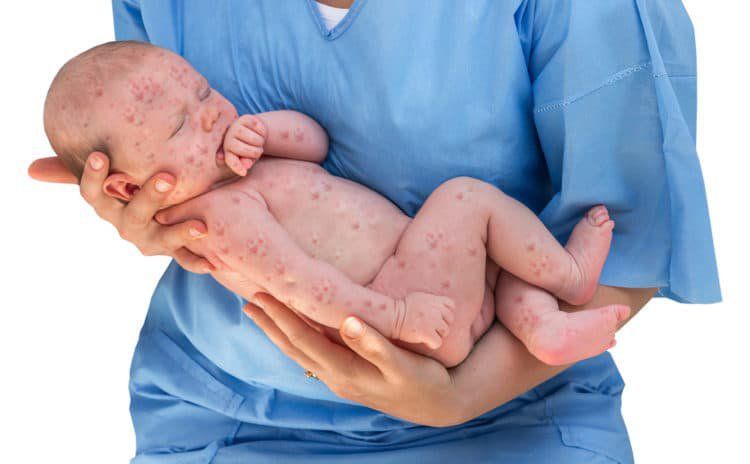 rubella-o-tre-so-sinh