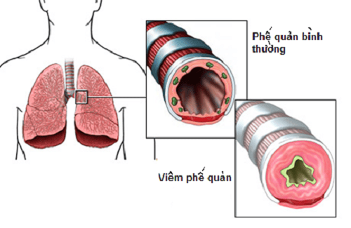 Viêm phế quản cấp