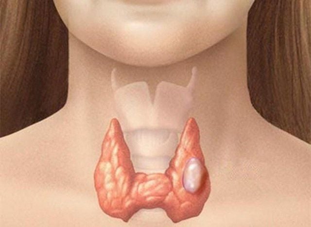 Nhân tuyến giáp là gì? Tổng quan từ triệu chứng đến điều trị 7 Tuyến giáp và các dạng nhân