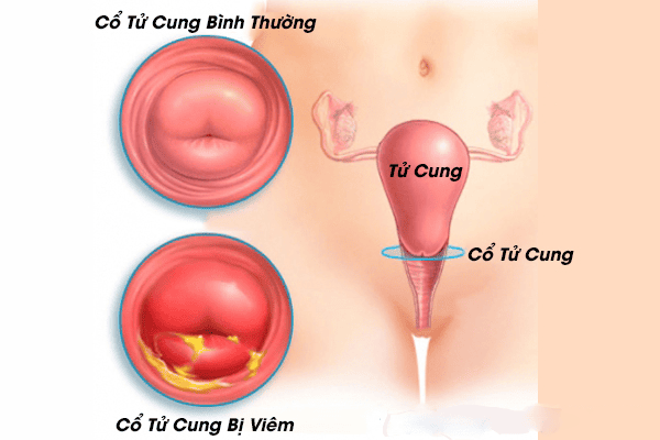 Viêm cổ tử cung là gì