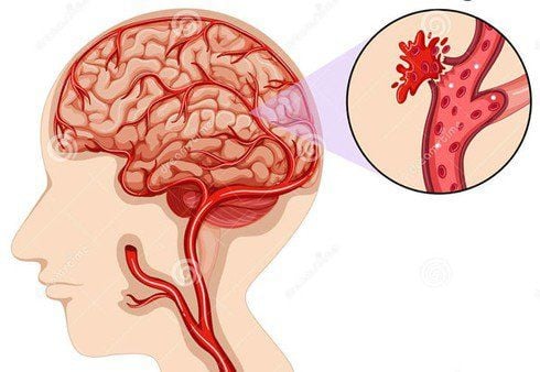 Đột quỵ xuất huyết não