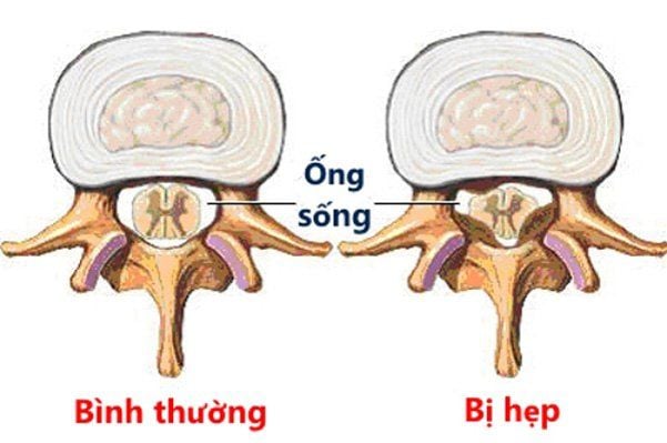 triệu chứng hẹp ống sống