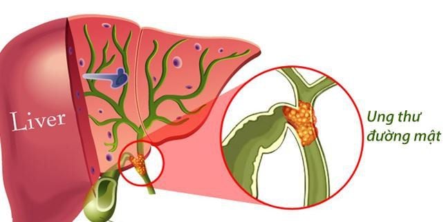chẩn đoán ung thư đường mật bằng MRI