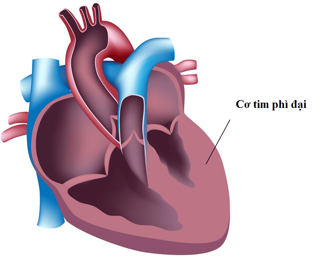 điều trị phì đại cơ tim do Fabry