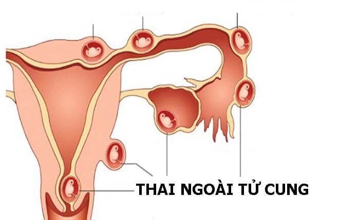 Thai ngoài tử cung giải phẫu