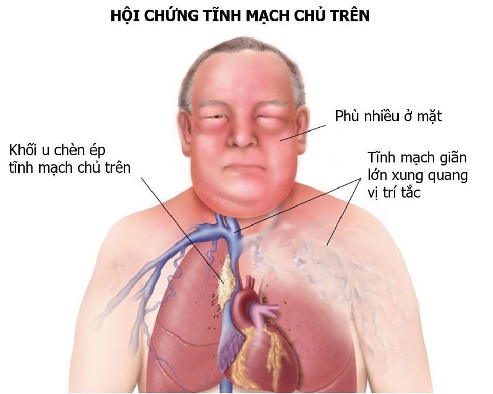 Giải phẫu tĩnh mạch chủ trên