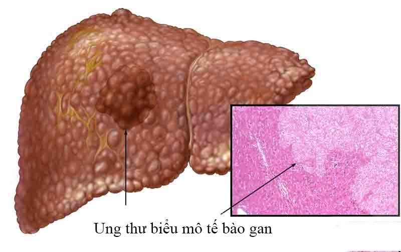Hình ảnh ung thư gan