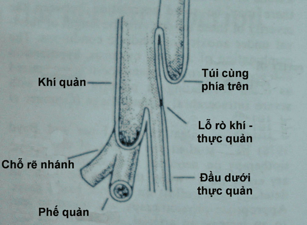 Sặc sữa do rò khí quản - thực quản ở trẻ sơ sinh
