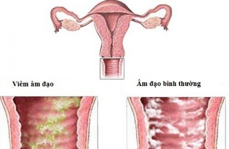 Viêm âm đạo do nấm Candida