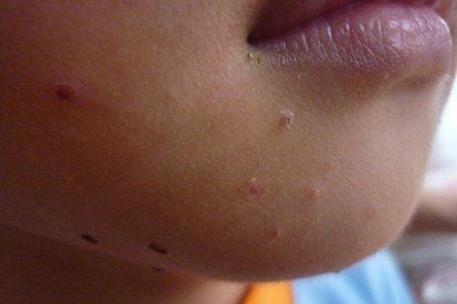 Triệu chứng u mềm lây