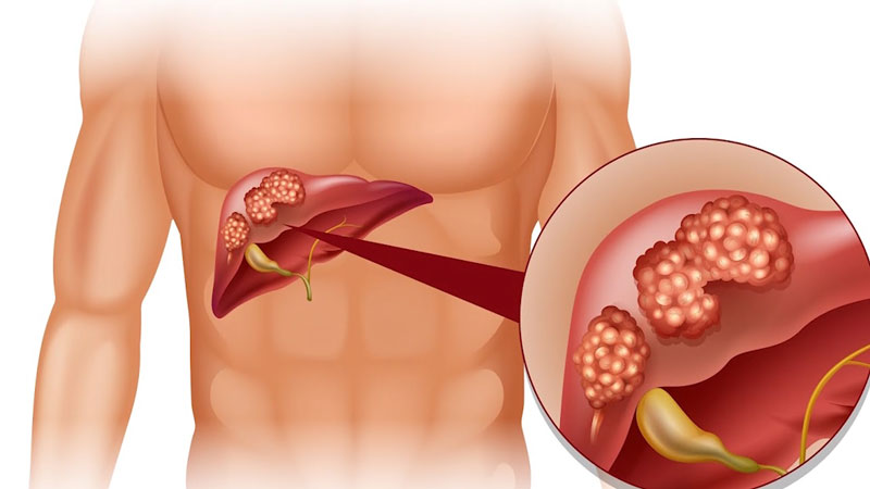 Đau hạ sườn phải liên quan đến bệnh gan