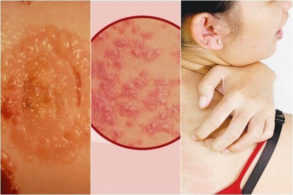Tổn thương điển hình pemphigus sùi