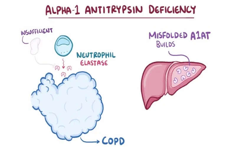 Vai trò của Alpha-1 antitrypsin trong cơ thể