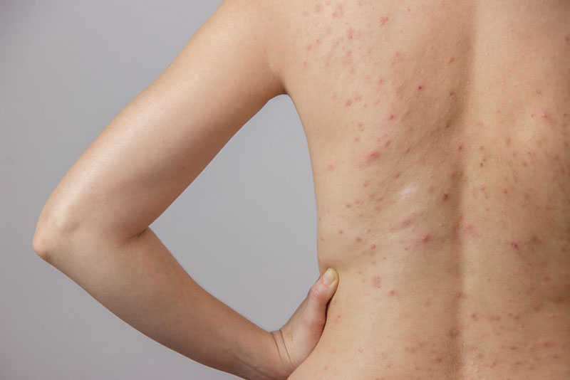 Viêm Da Tiết Bã: Kiến Thức Cần Biết Để Điều Trị Hiệu Quả 8 Nguyên nhân viêm da tiết bã