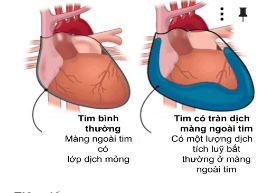 Ảnh X-quang tràn dịch màng ngoài tim